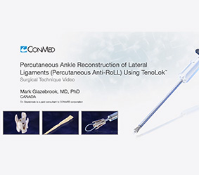 perc-ankle-recon-of-lateral-lig