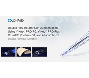 rotator-cuff-augmment